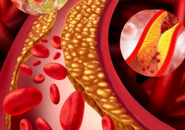 What is Cholesterol? High Cholesterol क्या होता है?